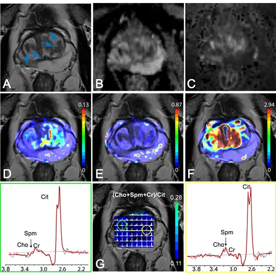 Multiparametric MRI (mpMRI)